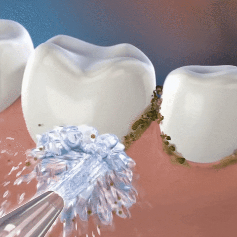 Dental Water Flosser